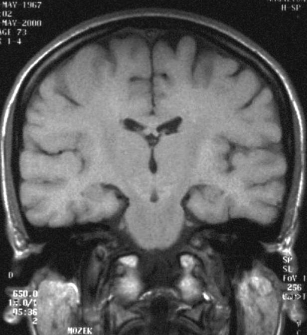 Anatomie CT, MR - Mozek metodika vyšetření baze lební obaly mozku likvorové