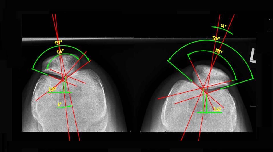 Obr. 43: Nativní RTG snímek obou kolenních kloubů s vyznačenými parametry hodnocení - proband č.