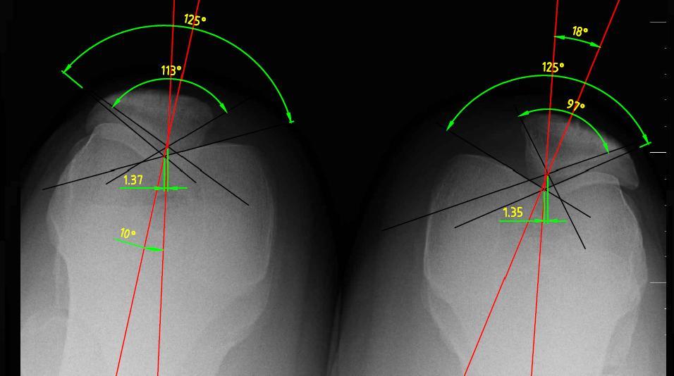 Obr. 47: Nativní RTG snímek obou kolenních kloubů s vyznačenými parametry hodnocení - proband č.