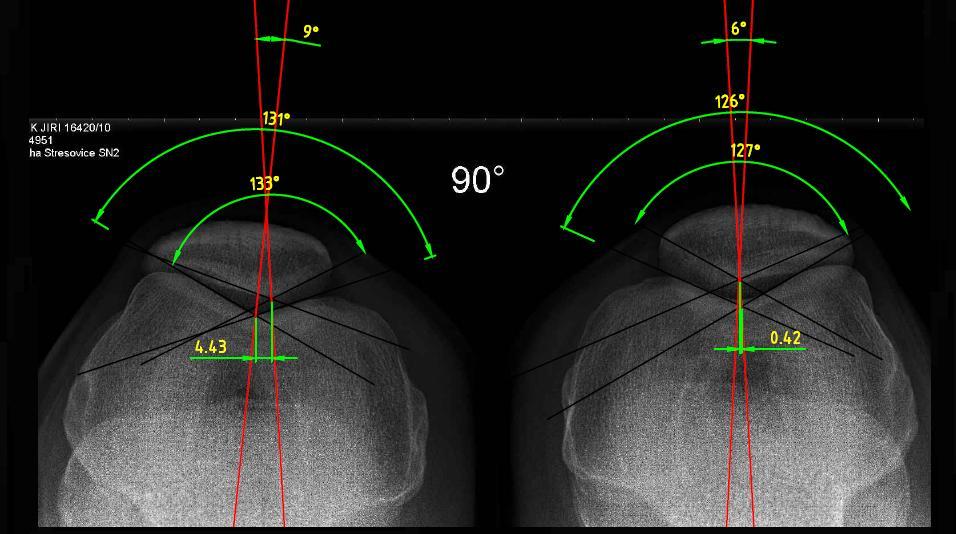Obr. 51: Nativní RTG snímek obou kolenních kloubů