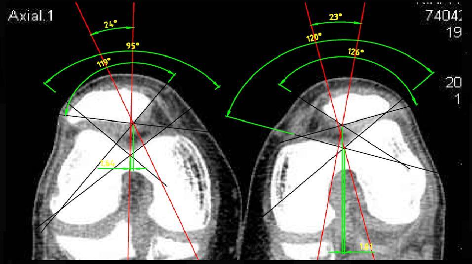 Obr. 53: CT axiální řez obou kolenních kloubů s vyznačenými parametry
