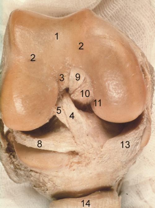 adductorium, na které se upíná šlacha ischiadické části m. adductor magnus. Obdobně na laterálním kondylu femuru nalezneme epicondylus lateralis, na němţ začíná zevní postranní vaz. a) b) Obr. 3.