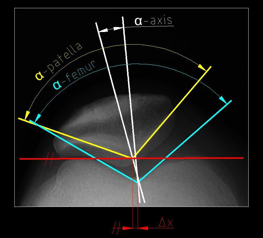 4.3.2 Přehled měřených parametrů radiologického vyšetření Schematicky jsou parametry znázorněny na obrázku 4.2. 1. α-femur [ ] úhel kloubní plochy tvořený kondyly femuru 2.