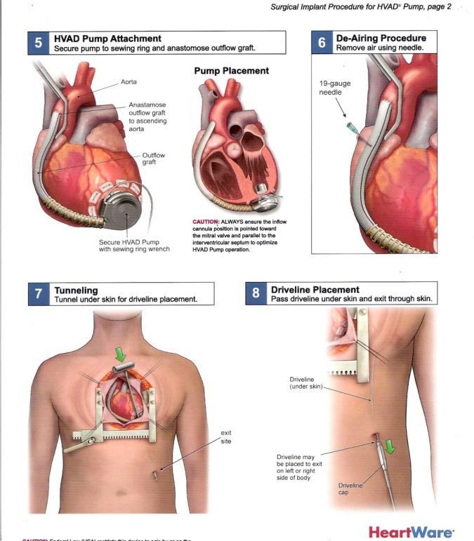 implantaci pumpy