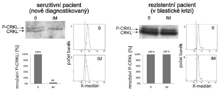 Obr. 4B - Monitorování in vitro senzitivity/rezistence leukocytů s BCR-ABL kinázy na imatinib u téhož nemocného z doby diagnózy (vlevo) a z období blastického zvratu (vpravo) pomocí Western blotu s