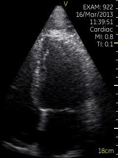 ADENOSIN kardioverze pravidelné