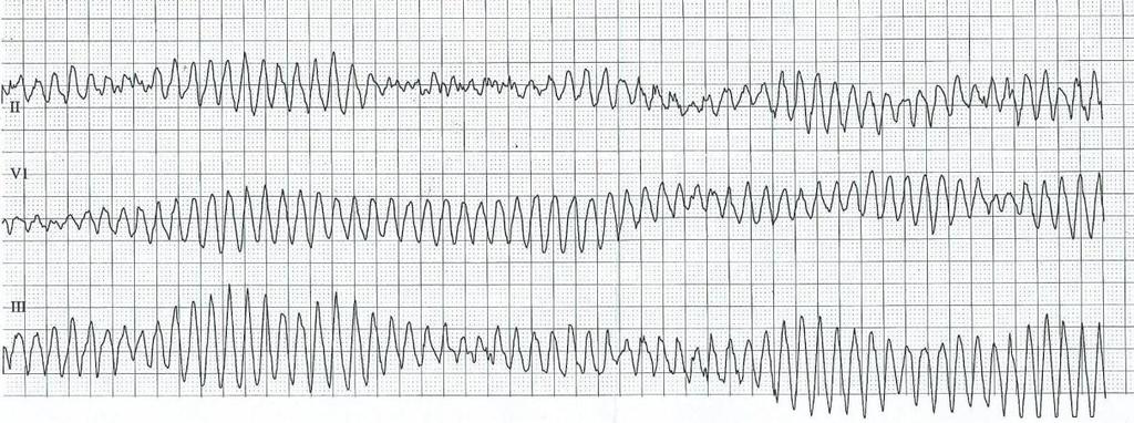 Klinický obraz: Obraz závisí na závažnosti hemodynamické poruchy, kterou způsobuje tachykardie.