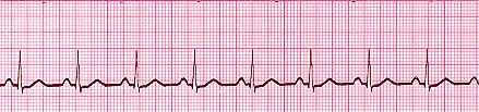 EKG u zdravého pacienta vypadá následovně: Obr. 2.5: EKG u zdravého pacienta (svod II.) [6] 2.4 Arytmie Jako arytmie se označují poruchy srdečního rytmu.