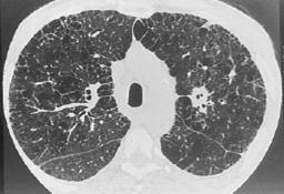 Artery Occlusion