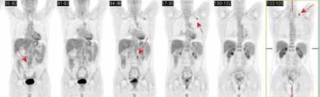 Summary Backgrounds: Colorectal cancer (CRC) is the second most frequent malignancy in the Czech Republic.