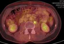 Obr. 2. PET + CT patologické ložisko v retroperitoneu. Obr. 3. PET + CT patologické ložisko infraklavikulárně vlevo. Obr. 4. PET + CT patologické ložisko v hrudní stěně vlevo. Obr. 5.