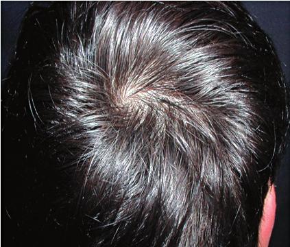 Jizvící alopecie: jediná z jizvících alopecií má relativní naději na úspěch léčby folliculitis decalvans (antibiotika eliminují stafylokoky).