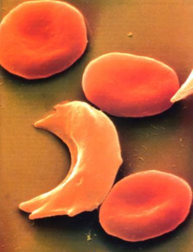 Rezistence vůči malárii Mutace v hemoglobinu mohou způsobit resistenci vůči