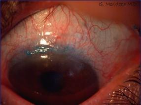 Teoretická část 24 Symptomy: Červené oko Oteklá víčka Silná bolest Pocit cizího tělíska v oku Rozmazané vidění Slzení U rozsáhlejšího stavu lze vřed vidět pouhým okem, viz Obrázek 15.