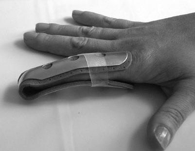 Příznaky: Bolestivost posledního článku prstu, otok, krevní výron pod nehtem. Při působení větší síly může dojít k poškození kožního krytu.