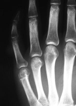 6) nebo pádem na ruku sevřenou v pěst, kdy dochází k odlomení distální (nejvzdálenější) části kosti záprstní, tzv. hlavičky (obr. 7). Většinou dochází k jejímu posunu z osy.