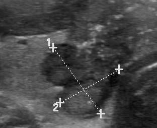 1,5 cm (ET 2 cm) Uzel se střední suspekcí EU-TIRADS 4 hypoechogenní solidní uzly FNAB 1 cm (ET 1,5 cm) Uzel s vysokou