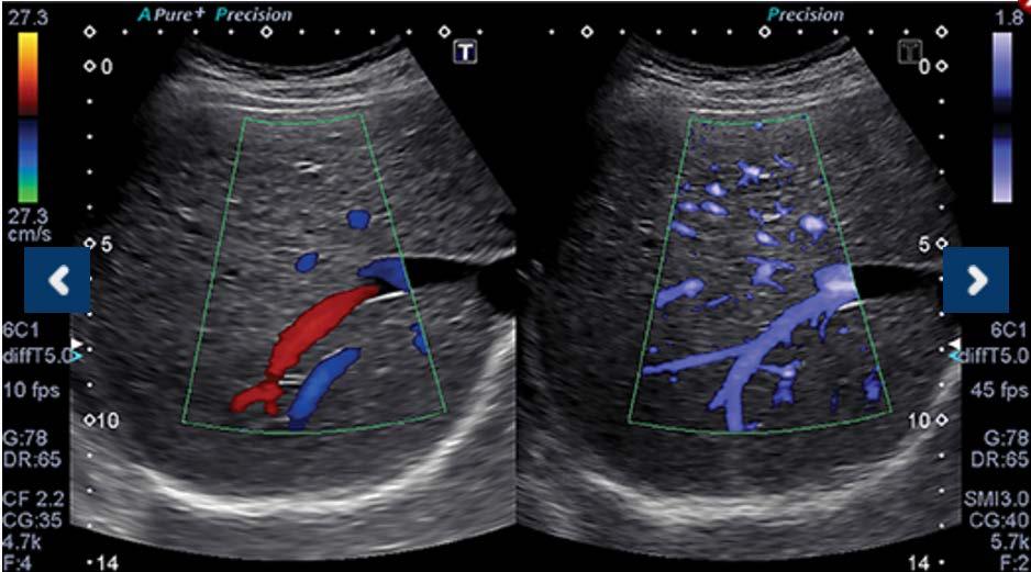 VIZUALIZACE MIKROVASKULARIZACE SUPERB MICROVASCULAR IMAGING (SMI)