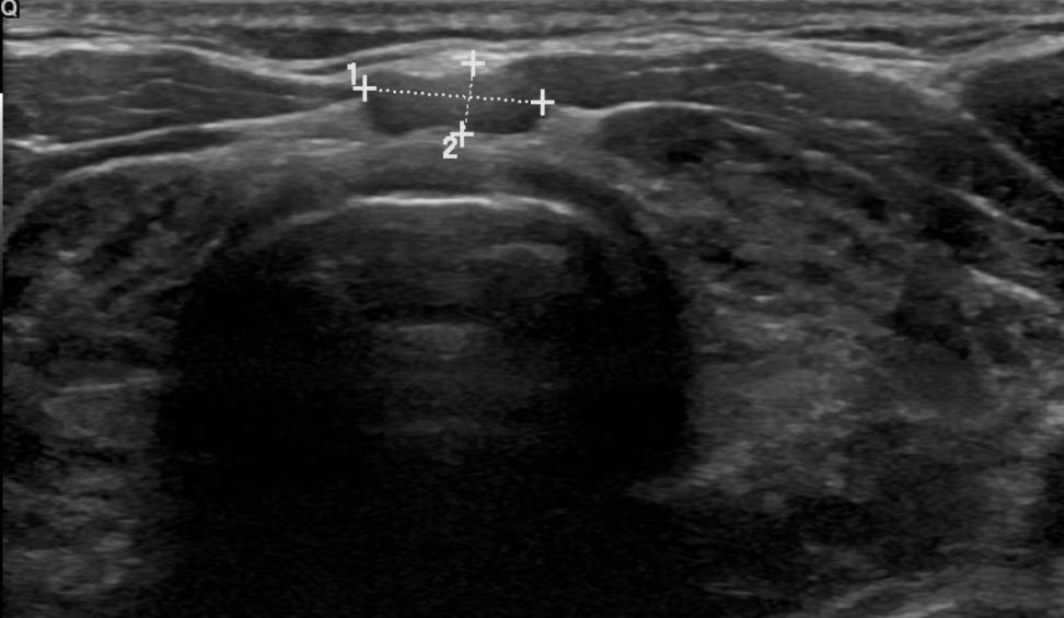 PSEUDONODUL U HASHIMOTOVY TYREOIDITIDY Isoechogenní/hyperechogenní riziko