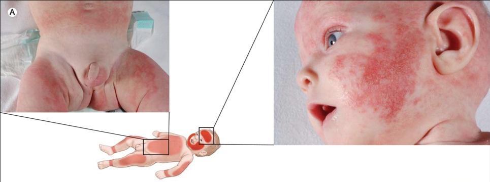 Obrázek 4:Typický klinický vzhled a umístění AD u dětí [49]. 3.1.