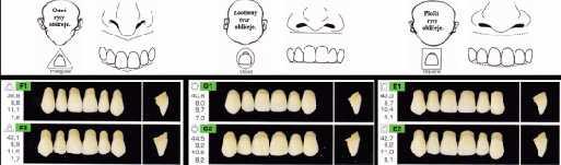 2.4.3.2 Kvadratický tvar zubů Používány pro mladší osoby s hranatým tvarem obličeje. Působí přirozeně, tam kde je potřeba napodobit málo obnažené vlastní zuby. 2.4.3.3 Ovoidní tvar zubů Zuby ovoidní případně oválné jsou použity u pacientů s kulatým tvarem obličeje, kde se nesnažíme dosáhnut nápadných atrofických změn alveolu.