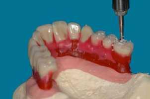 místech implantátů na šrouby (10) 14. Zkouška v ústech pacienta 15.