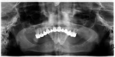 Obrázek 50 - stav DÚ před zavedením implantátů (vlastní zdroj) Obrázek 51 - stav DÚ po