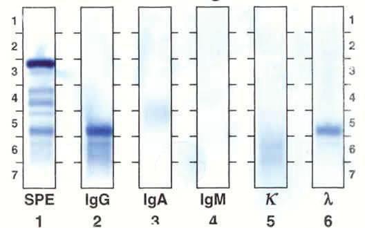 IMUNOFIXACE VZORKU SÉRA NEMOCNÉHO S PARAPROTEINEM IgG