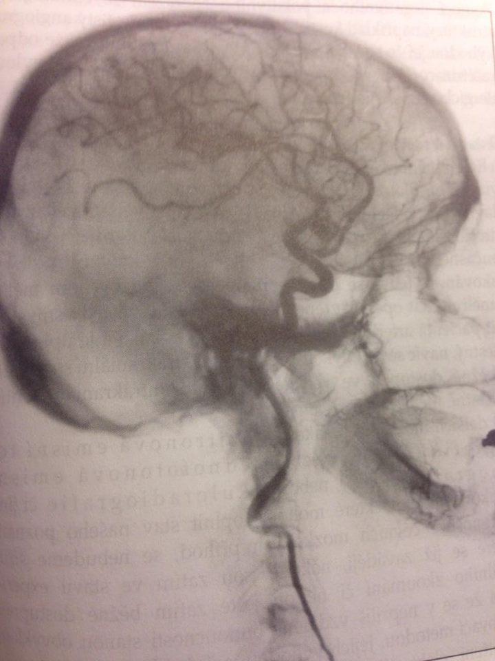 Obr. 1 Arteriografie, aneurysma (Országh, s. 75, 1995) Krvácení může být tříštivé, ohraničené, globózní a to v závislosti na výši krevního tlaku, velikosti ruptury cévní stěny a odporu okolní tkáně.