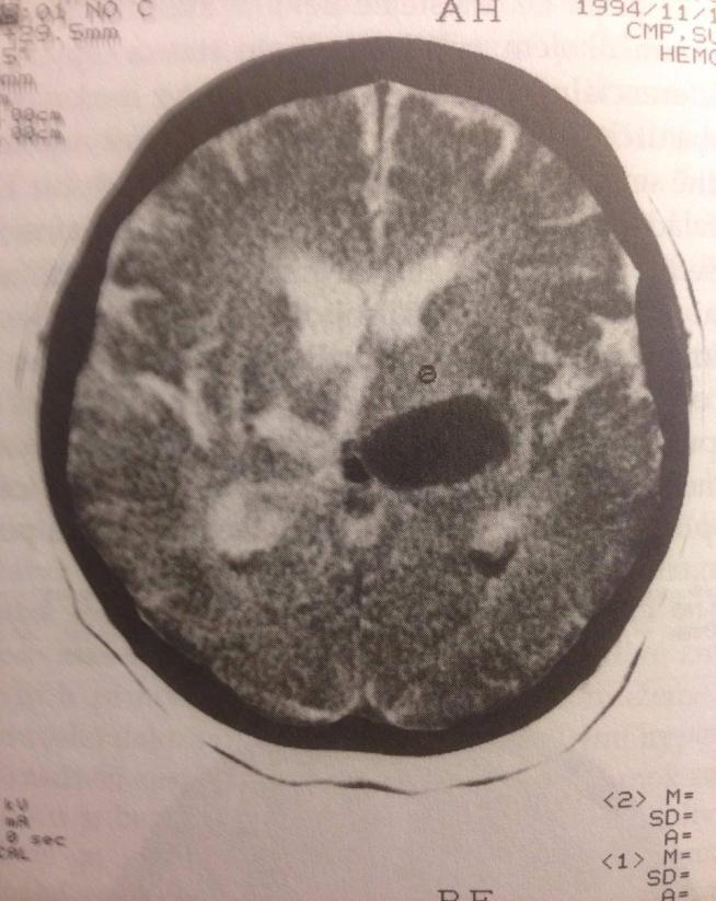 tomografii mozku. Většinou je známa pod pojmem CT. CT slouží k detekci stenózy či patologie tepen.