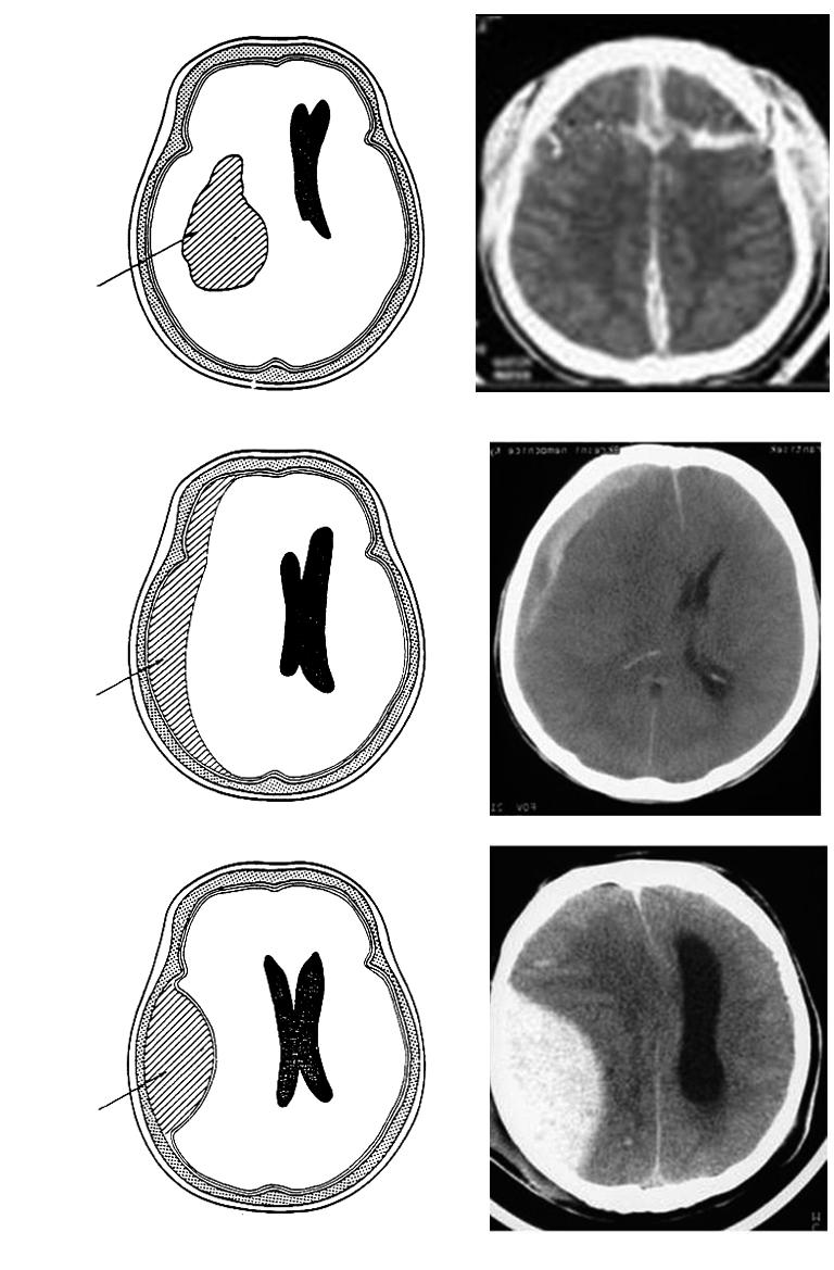 #1 Intracerebrální hematom Subdurální hematom Epidurální hematom Obr.