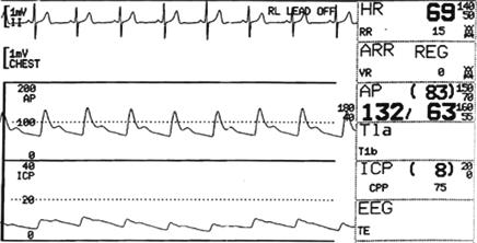 ICP velmi roste až na hodnoty 60 mmhg. Roste I arteriální tlak při tepové frekvenci. Po aplikaci relaxační medikace jsou všechny hodnoty prakticky normální. zdravotní a hygienické zásahy.