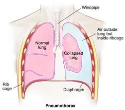 Pneumotorax plíce