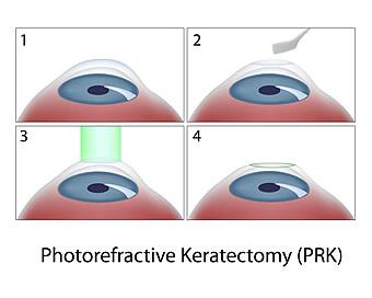 Rohovkové laserové zákroky 9 3.1 PRK (Photorefractive keratectomy) Laserový refrakční zákrok PRK patří mezi povrchové laserové refrakční zákroky.