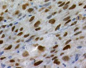 Obr. 1. Uroteliální karcinom, vyšetření míry exprese p53, zvětšení 200 Fig. 1. Urinary bladder carcinoma, immunohistochemistry of p53, 200 Obr. 2. Uroteliální karcinom, vyšetření míry exprese Ki-67, zvětšení 200 Fig.