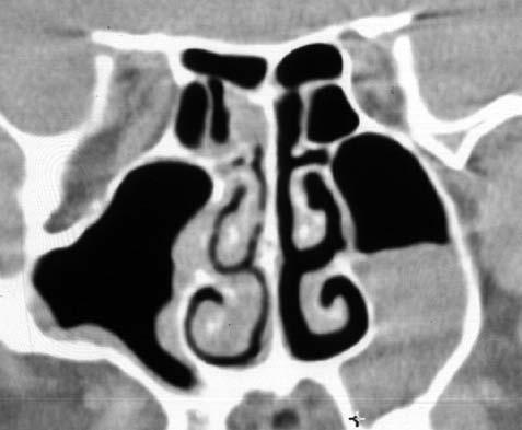 Anatomie IT IT A CT koronární rovina B T1 W MR obraz koronární rovina Obr. 1.