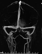 , 11 bulbus VJI, 12 VJI, 13 v. facialis comm., 14 v. retromandibularis, 15 v. facialis, 16 plexus pterygoideus, 17 v.