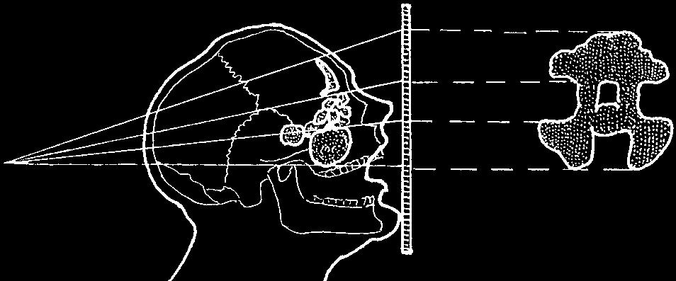 B: 1 sinus maxillaris, 2 sinus fron ta lis, 3 la by rin thus ethmoidalis, 4 sep tum si nu um fron ta li um, 5 septum nasi os se