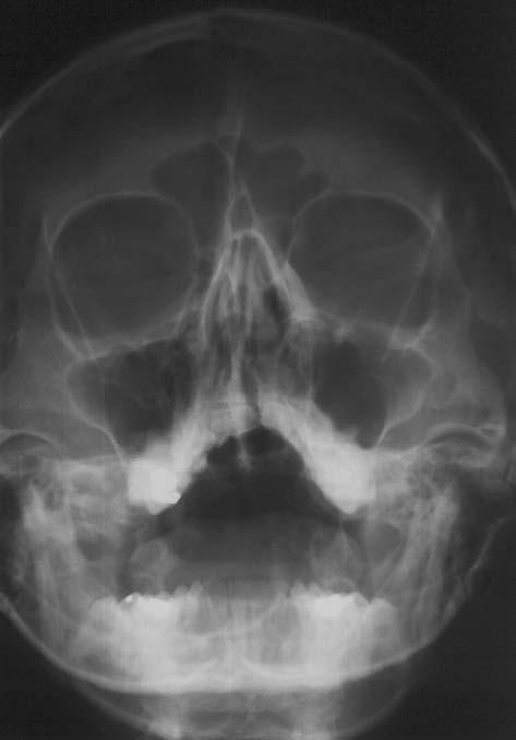 ma xil la ris (zevní okraj), 11 sinus maxillaris (dolní okraj), 12 orbita (nej niž ší část), 13 sinus maxillaris (horní okraj su