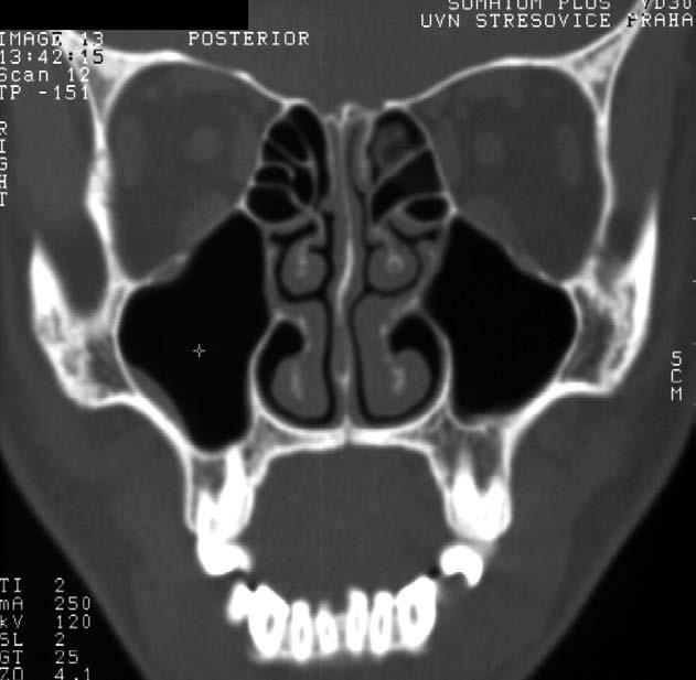 Anatomie A CT rekonstrukce v koronární rovině U MT B B 3D CT