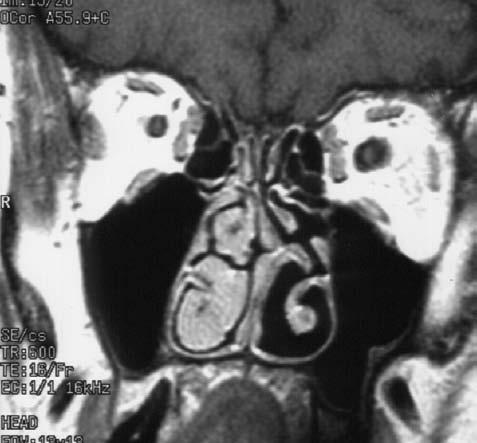 sinus sphe no i da lis lamina orbitalis ossis ethmoidalis m. obliquus su per i or m. levator palpebrae superioris corpus adi po sum orbitae m. tem po ra lis fascia m.