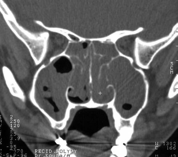 tem po ra lis, fissura orbitalis superior (SOF) a in fe ri or (IOF). Hrot orbity: n. II (II) a svaly orbity upínající se v anu lus tendineus communis Zinni. N.