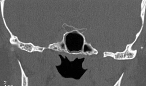 A: Lební baze v úrovni klínové du ti ny a hy po fý zy v koronární rovině glandula sublingualis tonsilla palatina lingua spatium parapharyngeale m. pterygoideus medialis Obr. 1.