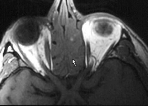 Anatomie OA II A T1 W MR obraz axiální rovina B T1 W MR obraz axiální rovina Obr. 1.88 A, B Chiasma opticum (*), n. II (II), a. ophthalmica (OA). Etmoidy na pě cho vá ny polypy (šipka) Obr.