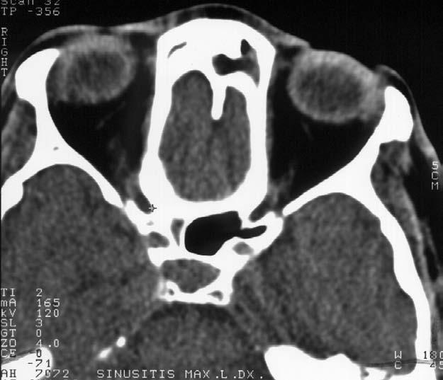 čelní dutiny a stropu orbity Obr. 1.93 A, B Crista galli (CG), m. levator palpebrae superioris a m.