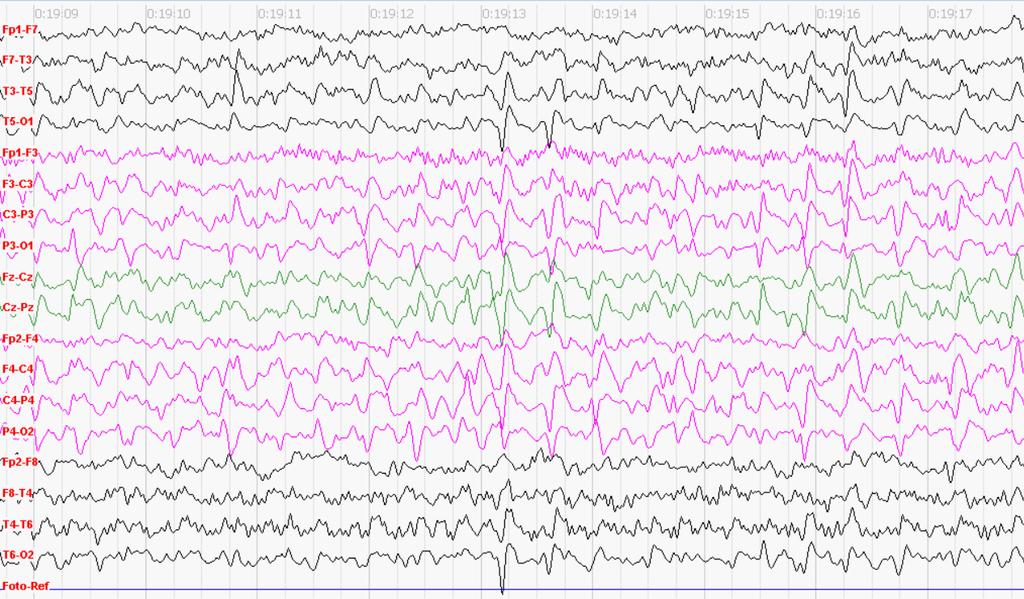 1. EEG vyšetření: první den po přijetí Kazuistika: Žena, Žena, 76 l.75 l. SW komplexy Závěr: Generalizovaný epileptický status nekonvulzivního typu kontinuálně bilat.