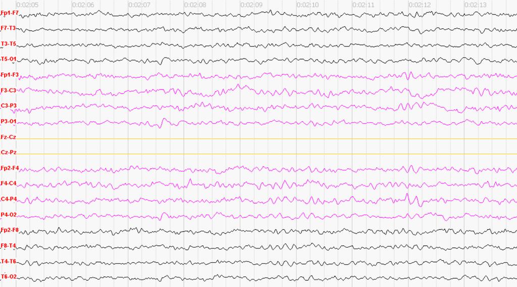 2. EEG vyšetření: Kazuistika: Žena, Žena, 76 l.75 l. následující den, při terapii midazolamem i. v. kont.
