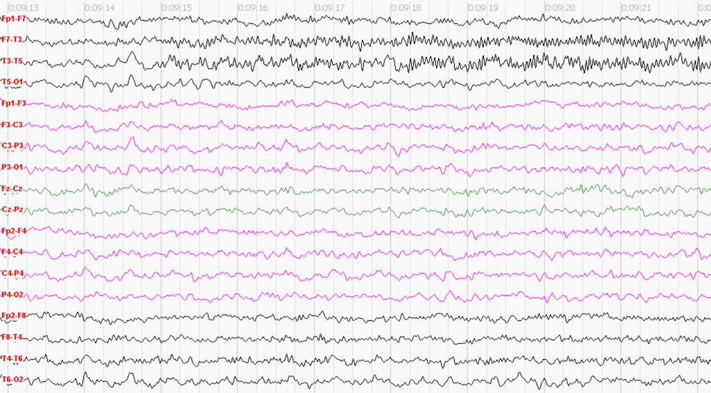 EEG vyšetření po týdnu Kazuistika: Žena, Žena, 76 l.75 l.