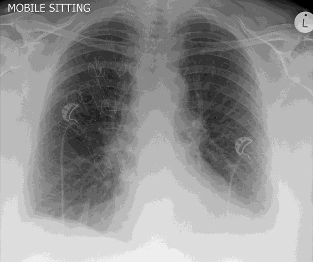 hrudníku, perikardu, pneumothorax