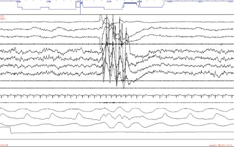 416 Prehľadové články Obr. 3. Polysomnografický záznam rytmických pohybů (30 sec). V průběhu REM spánku se objevuje pohybový artefakt při krátkých rytmických pohybech V horní části obrázku hypnogram.
